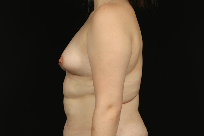 Breast Augmentation Mastopexy Before & After Gallery - Patient 112518 - Image 5