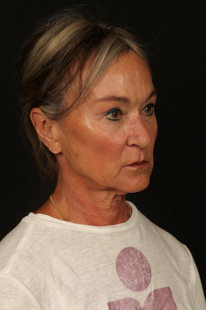 Facelift Before & After Gallery - Patient 247860 - Image 7