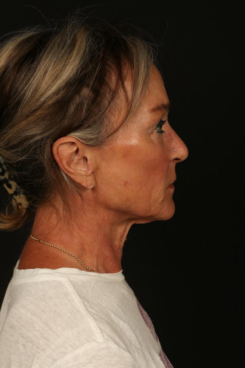 Facelift Before & After Gallery - Patient 247860 - Image 9
