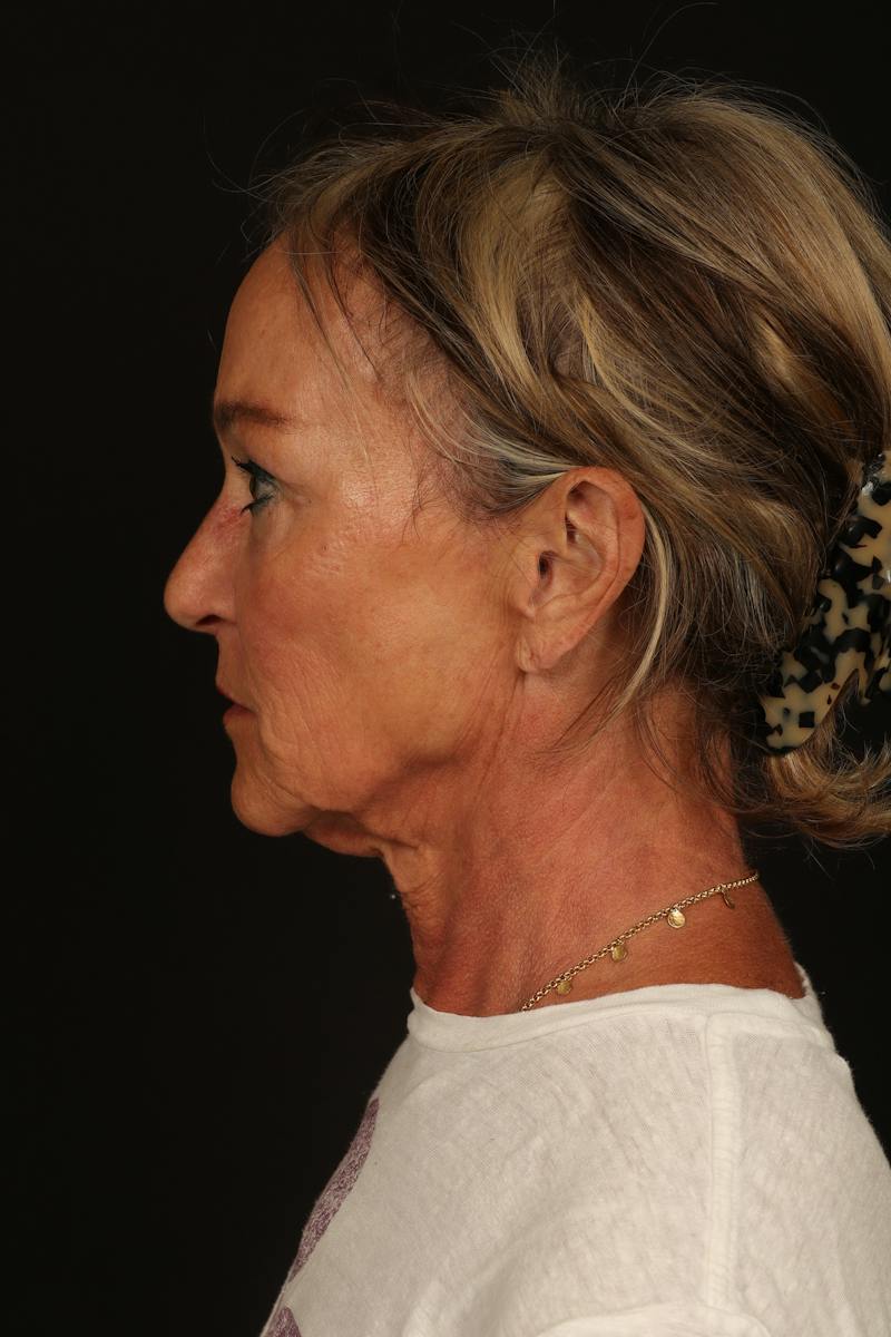 Facelift Before & After Gallery - Patient 247860 - Image 5