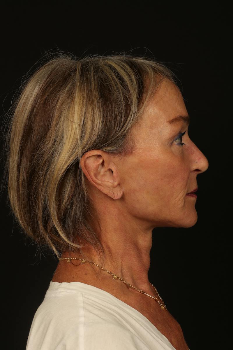 Facelift Before & After Gallery - Patient 247860 - Image 10