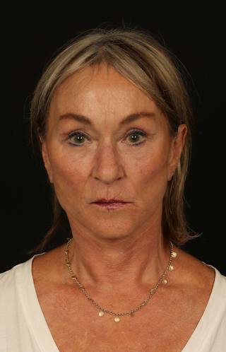 Facelift Before & After Gallery - Patient 247860 - Image 2