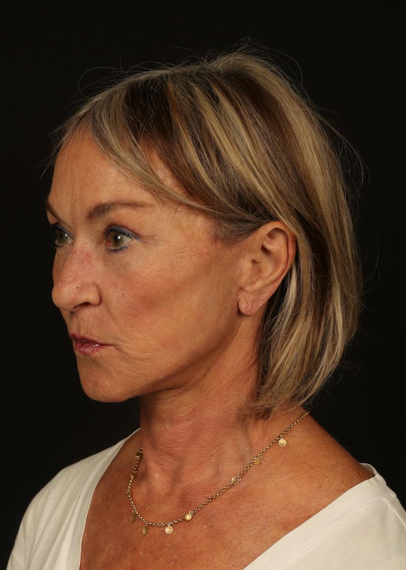 Facelift Before & After Gallery - Patient 247860 - Image 4