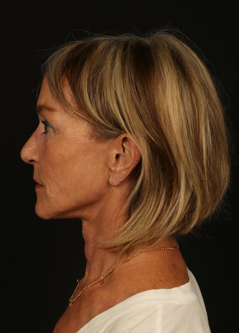 Facelift Before & After Gallery - Patient 247860 - Image 6