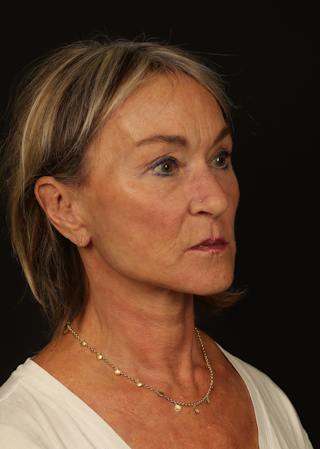Facelift Before & After Gallery - Patient 247860 - Image 8