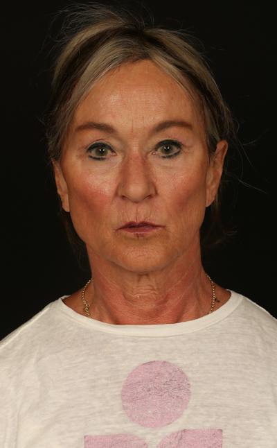 Facelift Before & After Gallery - Patient 247860 - Image 1