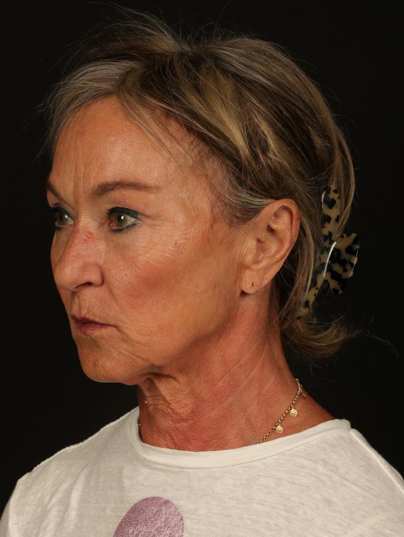 Facelift Before & After Gallery - Patient 247860 - Image 3