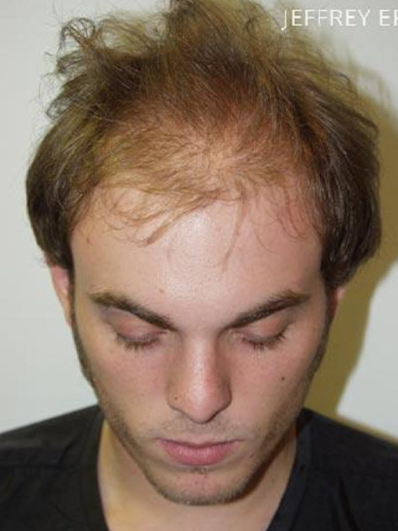 Hair Restoration for Men Before & After Gallery - Patient 247230 - Image 1