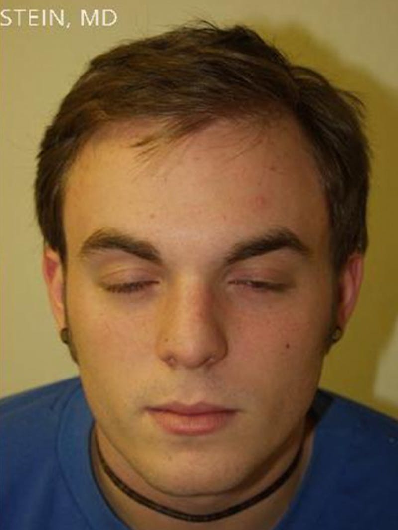 Hair Restoration for Men Before & After Gallery - Patient 247230 - Image 2