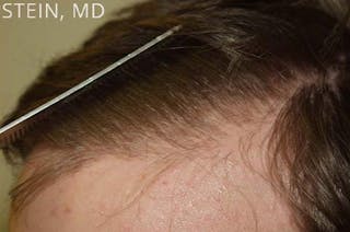 Hair Restoration for Men Before & After Gallery - Patient 320488 - Image 6