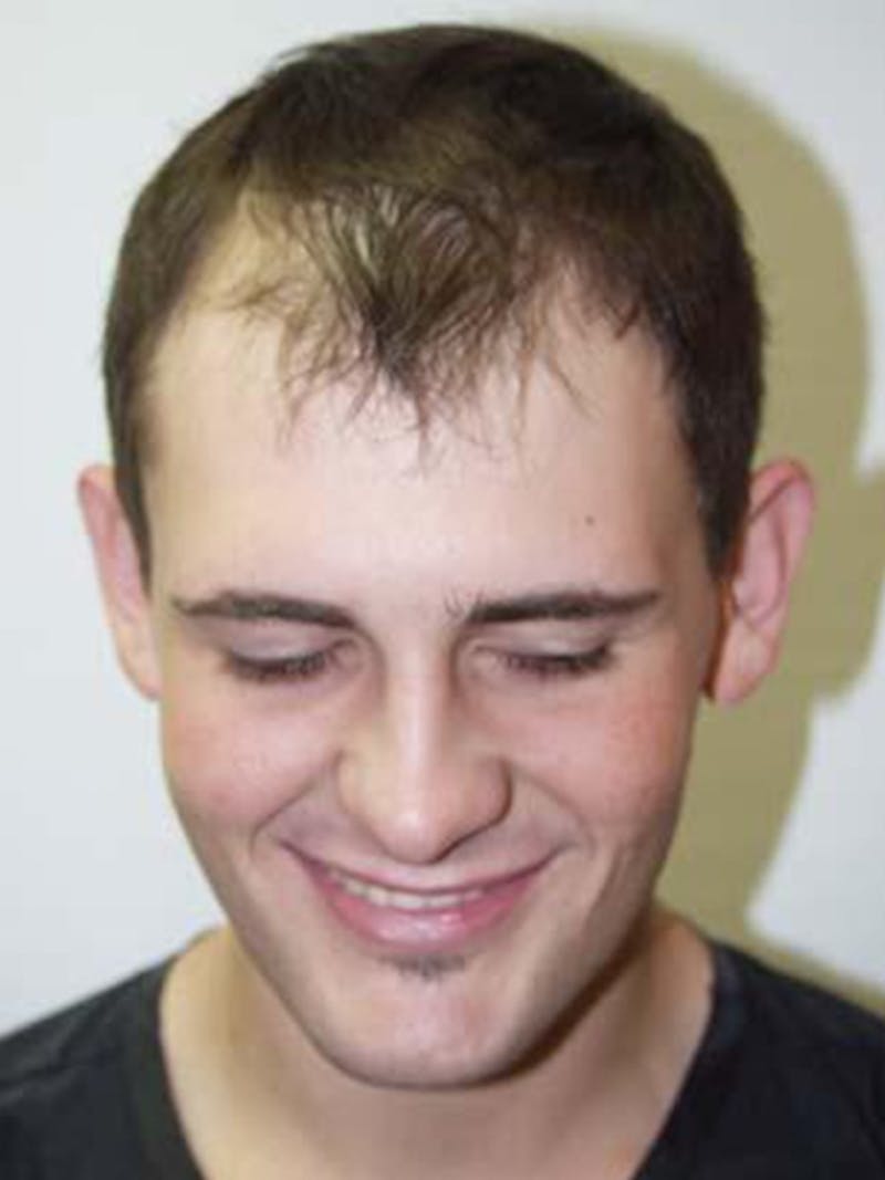 Hair Restoration for Men Before & After Gallery - Patient 331853 - Image 1