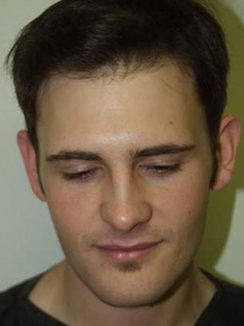 Hair Restoration for Men Before & After Gallery - Patient 331853 - Image 2