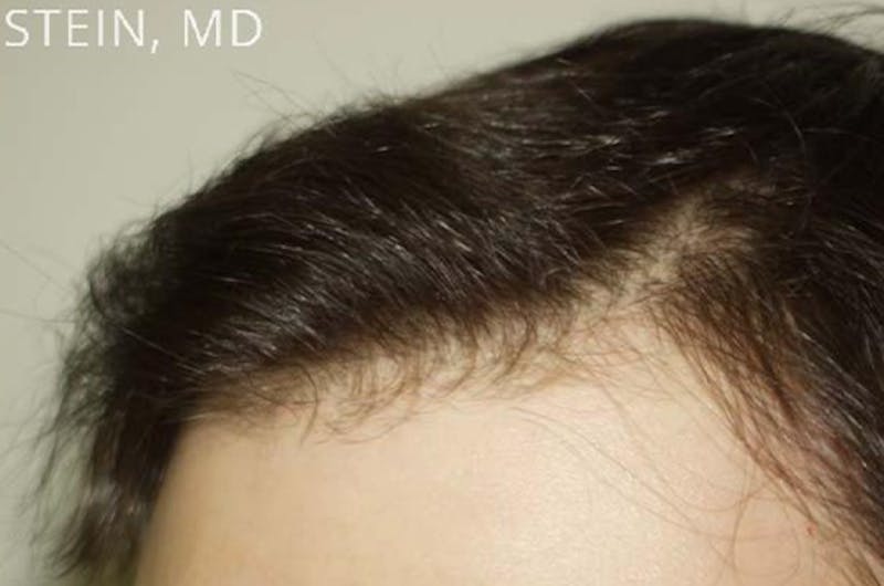 Hair Restoration for Men Before & After Gallery - Patient 331853 - Image 6