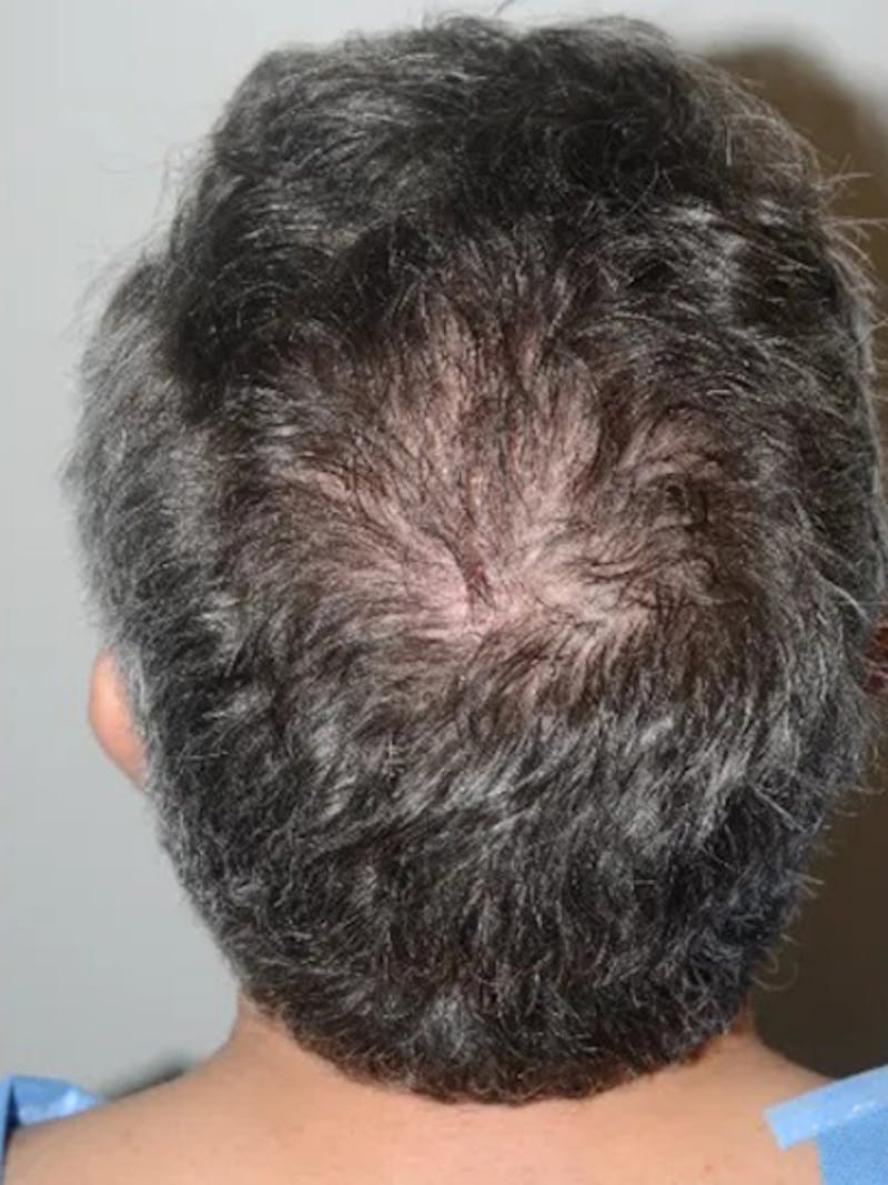 Body Hair Transplants Before & After Gallery - Patient 286370 - Image 1