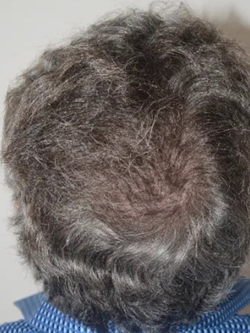 Body Hair Transplants Before & After Gallery - Patient 286370 - Image 2