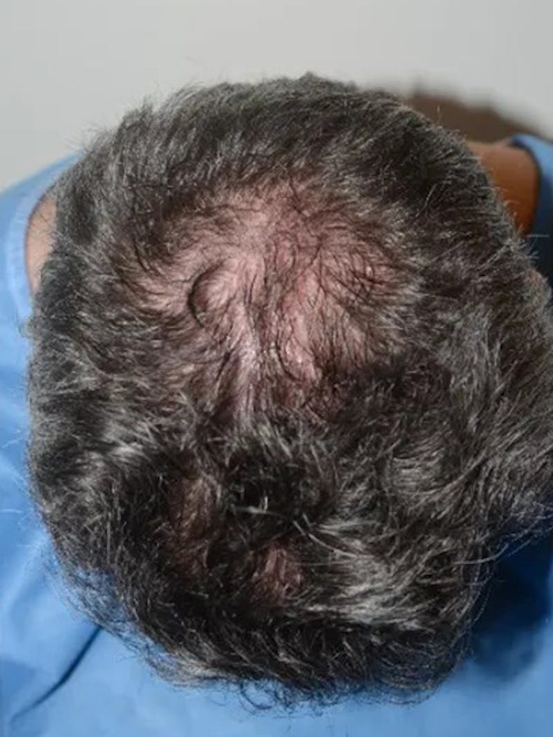 Body Hair Transplants Before & After Gallery - Patient 286370 - Image 3