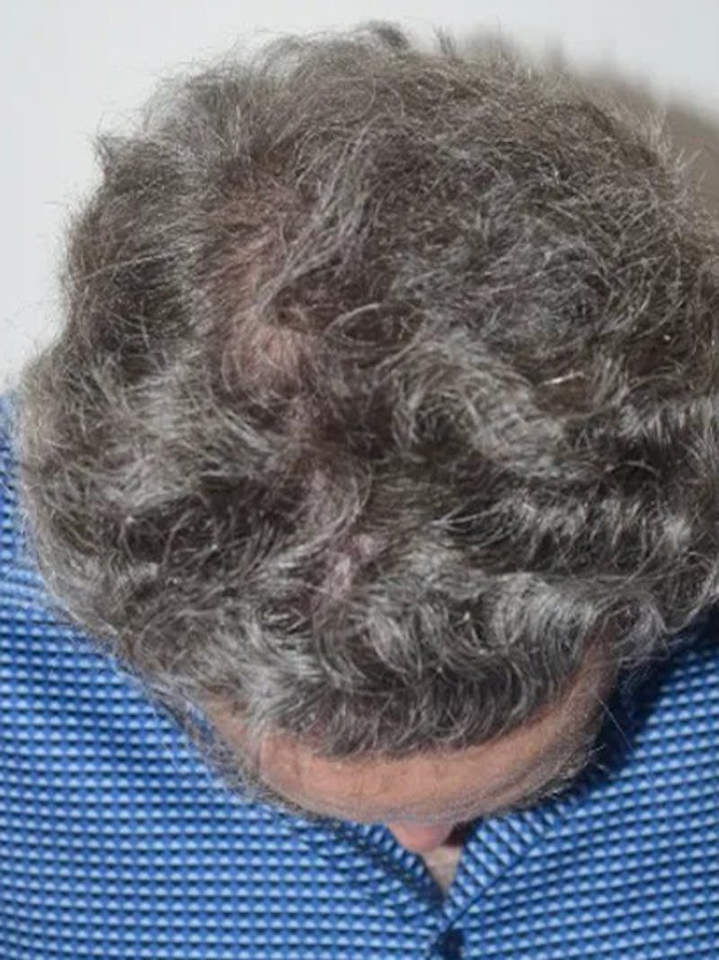Body Hair Transplants Before & After Gallery - Patient 286370 - Image 4