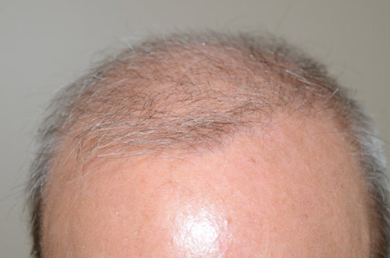 Close-up Donor Sites Before & After Gallery - Patient 258547 - Image 1