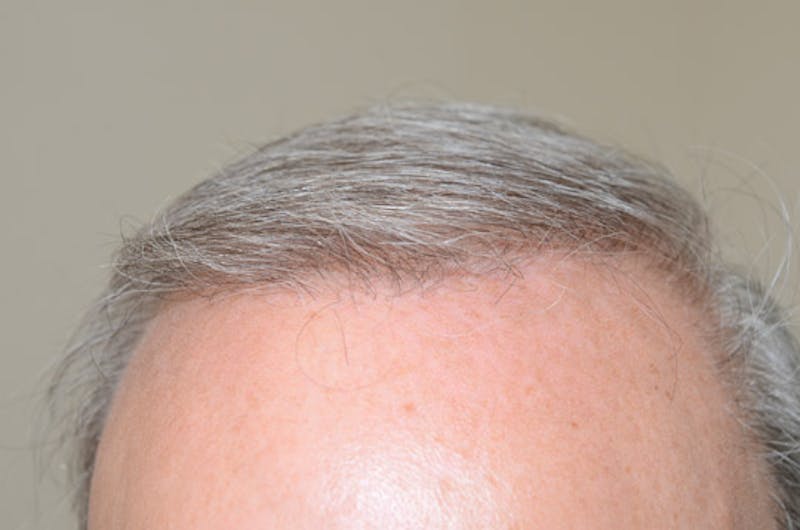 Close-up Donor Sites Before & After Gallery - Patient 258547 - Image 2