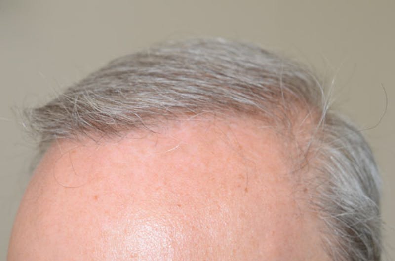 Close-up Donor Sites Before & After Gallery - Patient 258547 - Image 4