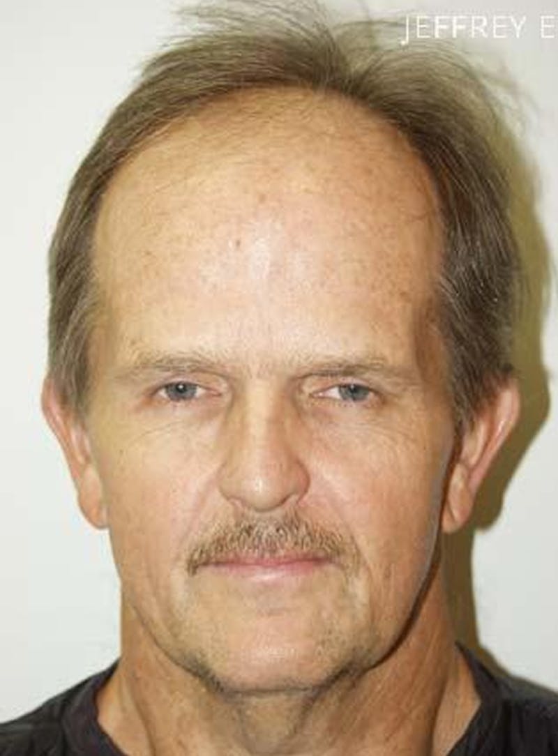 Body Hair Transplants Before & After Gallery - Patient 289518 - Image 1