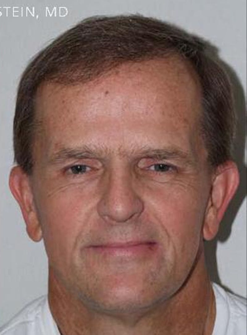 Body Hair Transplants Before & After Gallery - Patient 289518 - Image 2