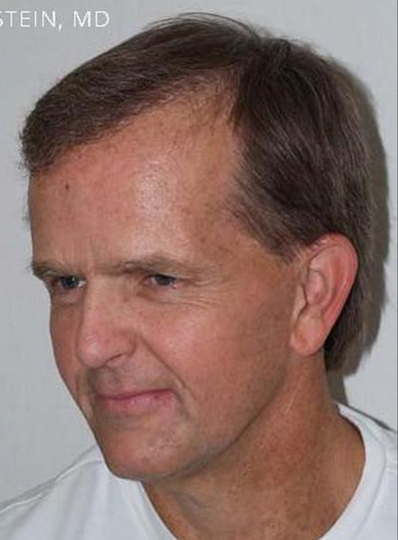 Body Hair Transplants Before & After Gallery - Patient 289518 - Image 4