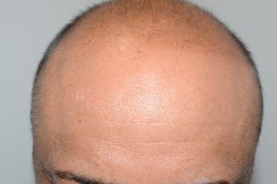 Body Hair Transplants Before & After Gallery - Patient 853589 - Image 1