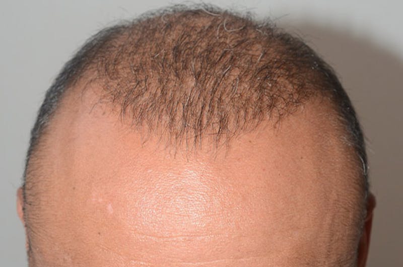 Close-up Donor Sites Before & After Gallery - Patient 370718 - Image 2