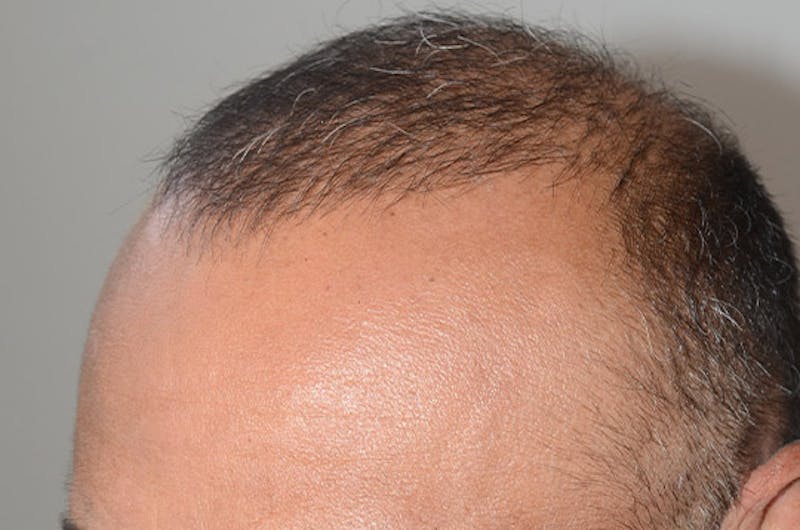 Close-up Donor Sites Before & After Gallery - Patient 370718 - Image 4