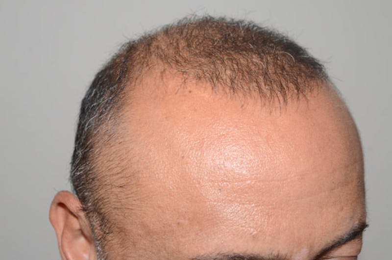 Close-up Donor Sites Before & After Gallery - Patient 370718 - Image 6