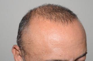 Body Hair Transplants Before & After Gallery - Patient 853589 - Image 6