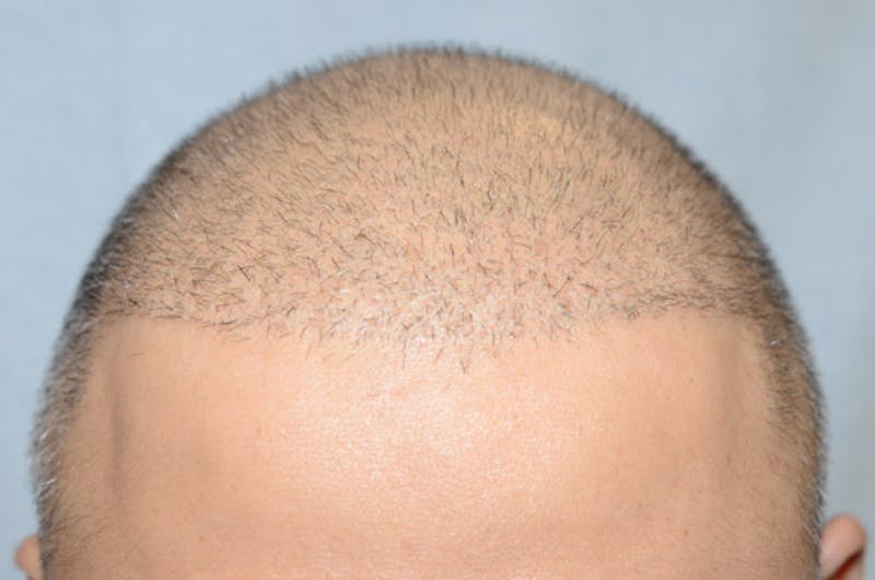 Close-up Donor Sites Before & After Gallery - Patient 393610 - Image 1