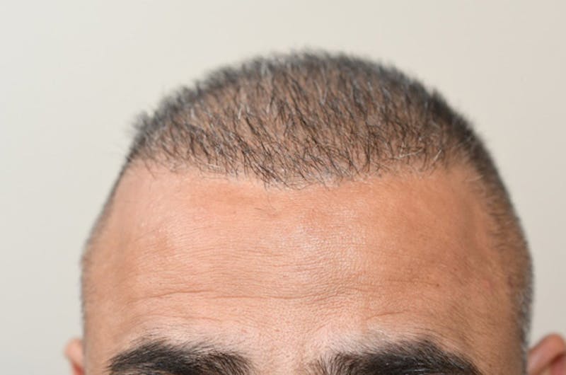 Close-up Donor Sites Before & After Gallery - Patient 393610 - Image 2