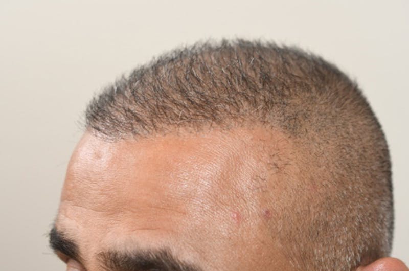 Close-up Donor Sites Before & After Gallery - Patient 393610 - Image 4