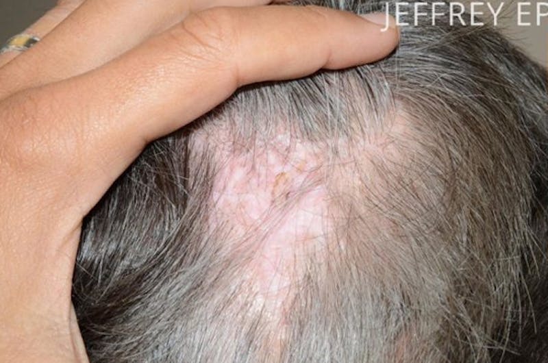 Hair Transplant Repair Before & After Gallery - Patient 273694 - Image 1