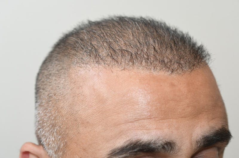 Close-up Donor Sites Before & After Gallery - Patient 393610 - Image 6