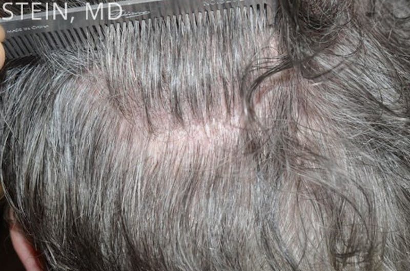 Hair Transplant Repair Before & After Gallery - Patient 273694 - Image 2
