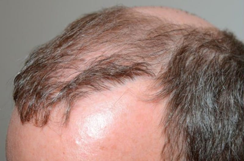 Body Hair Transplants Before & After Gallery - Patient 362612 - Image 1