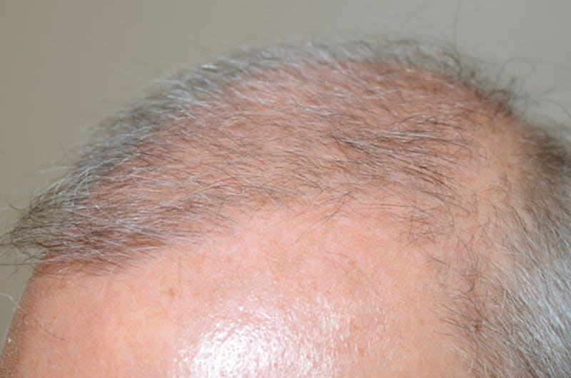 Close-up Donor Sites Before & After Gallery - Patient 258547 - Image 3