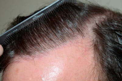 Body Hair Transplants Before & After Gallery - Patient 341592 - Image 2