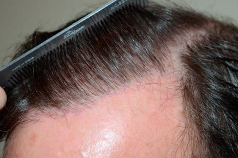 Body Hair Transplants Before & After Gallery - Patient 362612 - Image 2