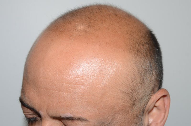 Close-up Donor Sites Before & After Gallery - Patient 370718 - Image 3