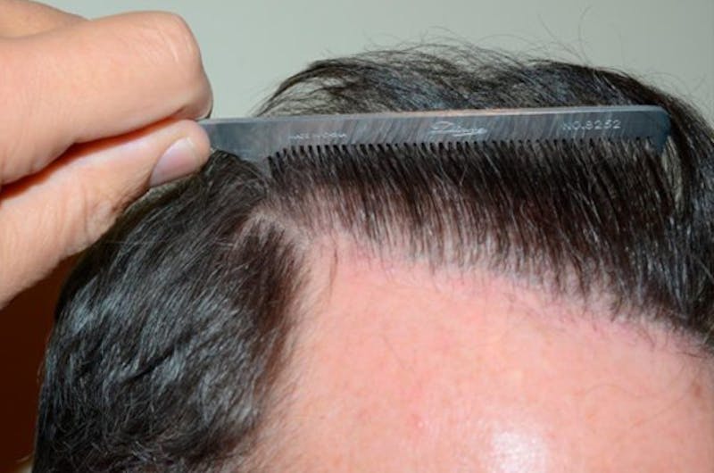 Body Hair Transplants Before & After Gallery - Patient 362612 - Image 4