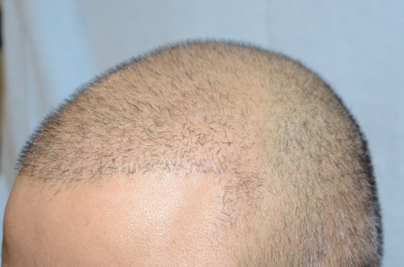 Close-up Donor Sites Before & After Gallery - Patient 393610 - Image 3