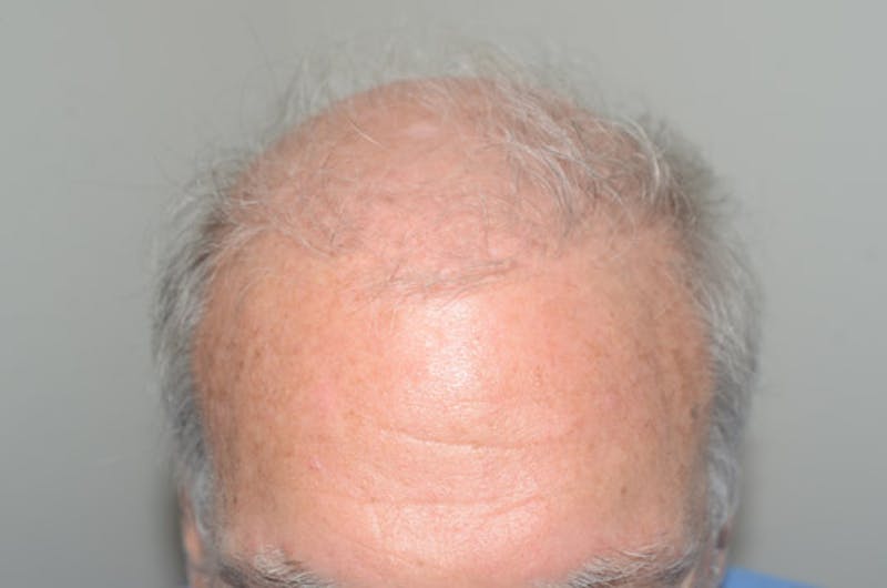 Body Hair Transplants Before & After Gallery - Patient 242865 - Image 1