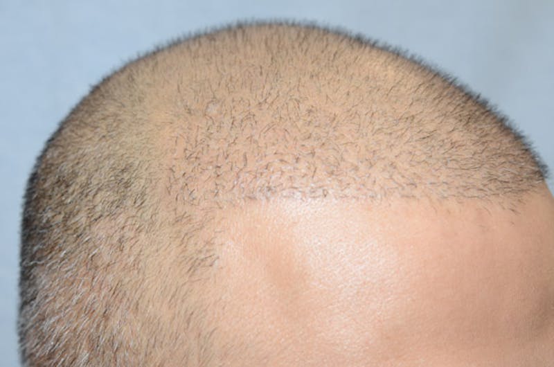 Close-up Donor Sites Before & After Gallery - Patient 393610 - Image 5