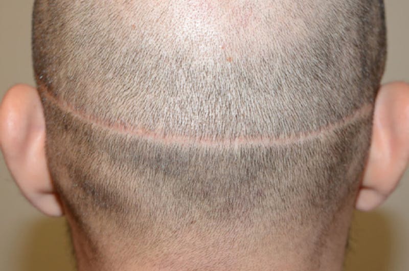 Hair Transplant Repair Before & After Gallery - Patient 137153 - Image 1