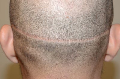 Hair Transplant Repair Before & After Gallery - Patient 434021 - Image 1