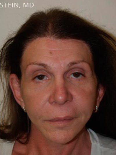 Hair For Gender Reaffirmation Before & After Gallery - Patient 150648 - Image 2